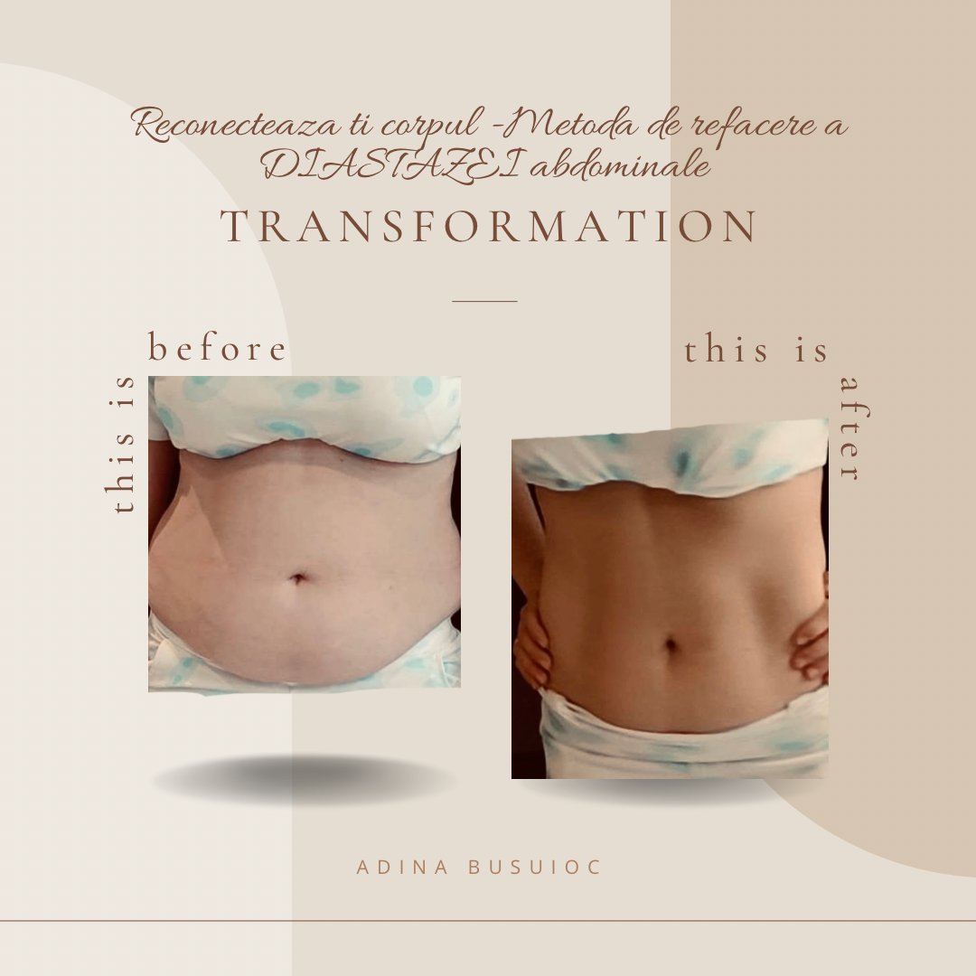 Transformare — refacere diastază abdominală